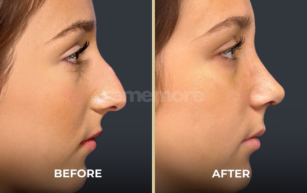 rhinoplasty before and after